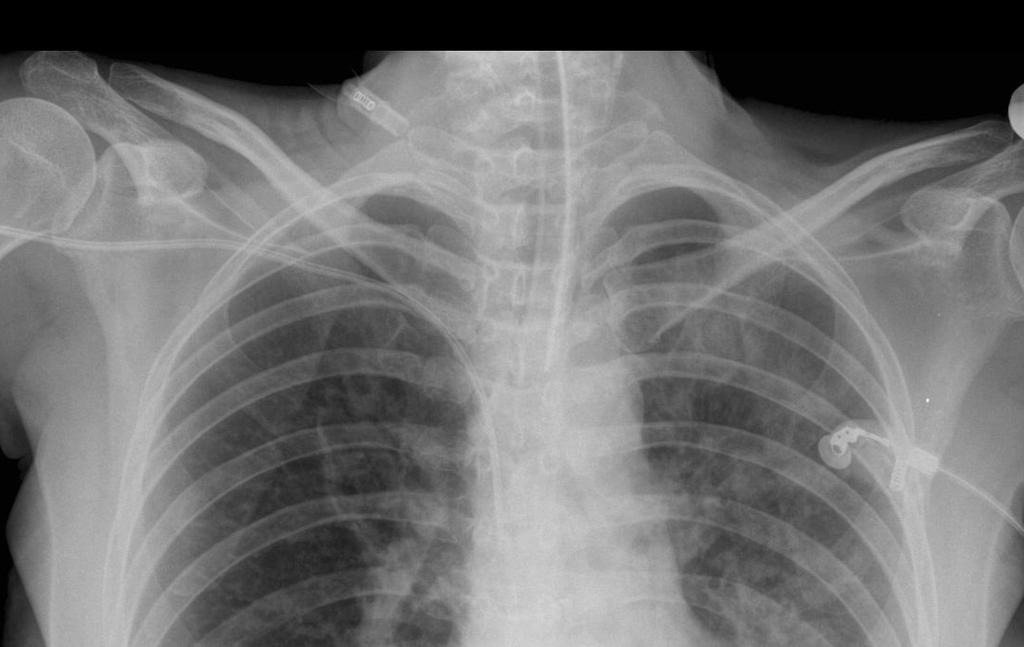 fibrinogén-pcc; CIT 458 min,