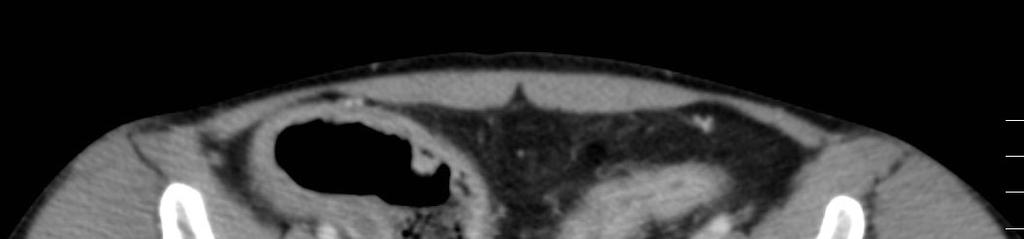 MTx + Colitis ulcerosa: akut fázis Klinikai diagnózis: Cirrhosis hep., Colitis ulcerosa.