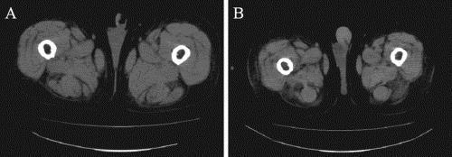 Mérések a gyakorlatban 1.nap 7.nap Effect of transcutaneous electrical muscle stimulation on muscle volume in patients with septic shock Poulsen, Jesper B.