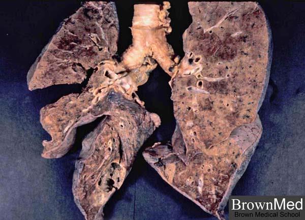 Klebsiella pneumoniae normál bélflóra tagja Patogenitás: lebenyes tüdőgyulladás (Friedländer-pneumonia) húgyúti,