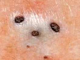 Pathomechanizmus Többszörös nyílással rendelkező comedo korai jel Folliculus epithelium elváltozásai megelőzik az infekciót Psoriasiform hyperplasia, KI67+ Folliculus dugó kialakulása Folliculus
