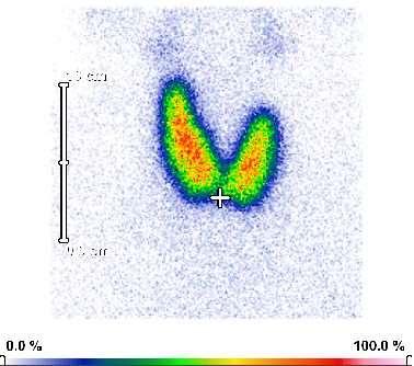 Diffúz strúma A szcintigram egy Basedowkóros
