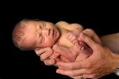 Sugárvédelem koraszülöttekújszülöttek 1. A röntgenezett gyermek:koraszülött minél kisebb, annál betegebb, annál több felvétel készül róla (kumulativ dózis ). 2.
