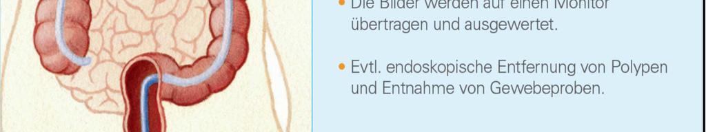 A KOLONOSZKÓPIA A kamera által rögzített képeket kivetítik és a vizsgálóorvos a monitoron