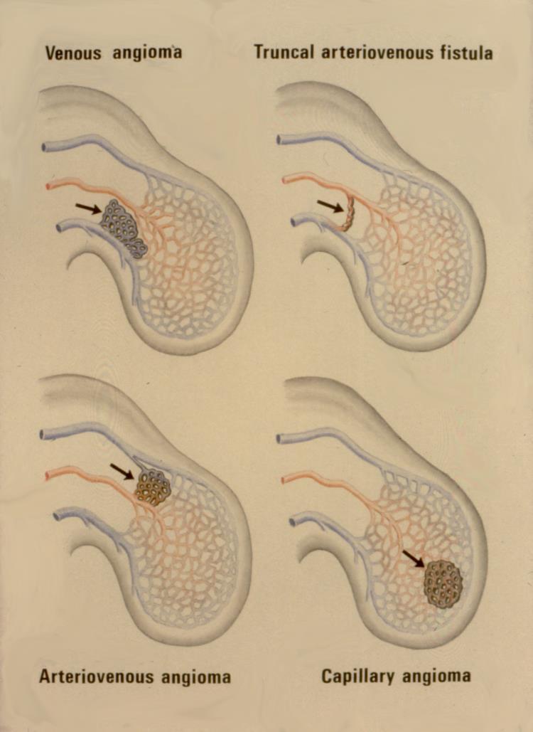 JÓINDULATÚ HAEMANGIOMÁK OSZTÁLYOZÁSA Capillaris haemangioma Cavernosus haemangioma Venosus