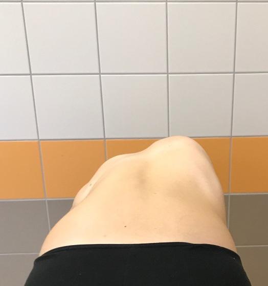 A befekvés napján vérvétel; ha szükséges: röntgenfelvétel, CT vizsgálat; illetve ha korábban nem történt, ekkor kerül sor az aneszteziológiai konzultációra is.