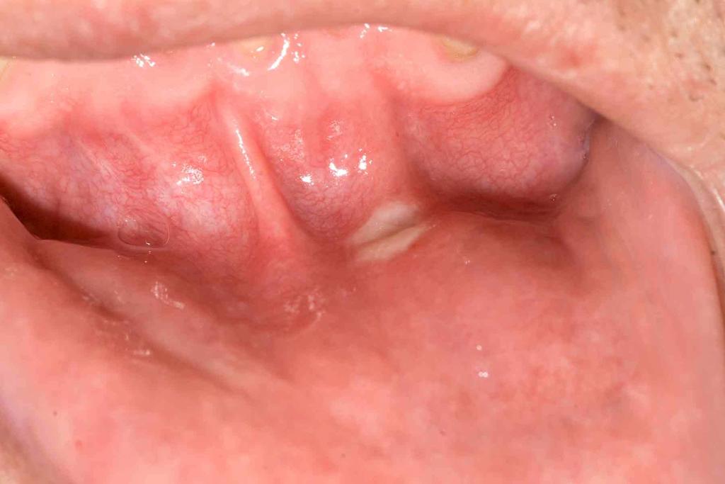 Stomatitis és a célzott kezelés Preventivenció, lokális kezelés és megfelelő szájhigiéne szerepe Legtöbbször stomatitis miatt nem szükséges a