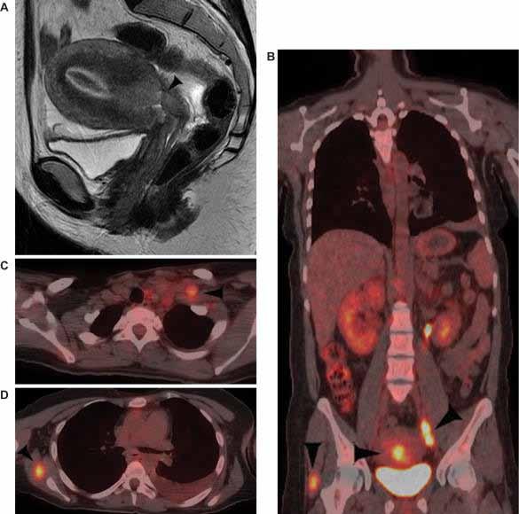 Méhnyakrák (a) Sagittalis T2- súlyozott MRI (b) coronalis fusiós PET/CT primer tu. és nycs. (nyil), (c) axialis fúziós PET/CT bal o.