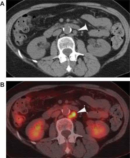 . Iyer RB, Balachandran A, Devine CE. Cancer Imaging.