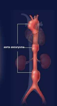 pszichés terhelés hatására következik be. Dissecáló aneurysma azonban fiatalokban is kialakulhat, főként Marfan-syndroma fennállása mellett. [9] 3.