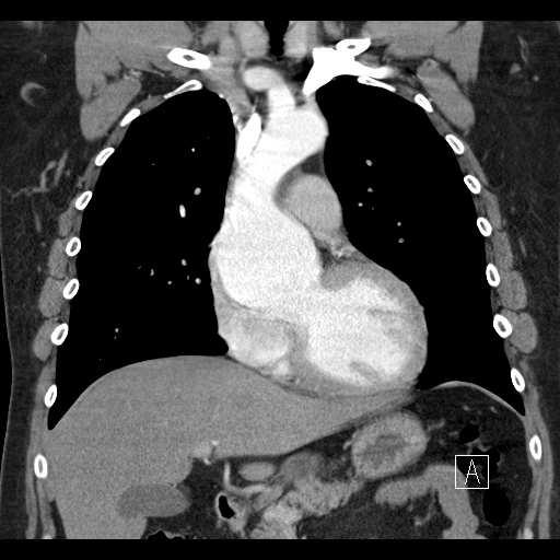 A diagnózisban, illetve a betegség felismerésében nagy segítség a mellkas röntgenfelvétel, ahol láthatóvá válik az aorta gomb kiszélesedése és a légcső eltolódása.