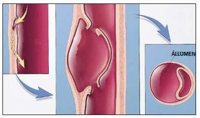 kiáramlás mellett aorta abdominálison is előfordul); csigolya, sternumusuratio (lényegében fedett perforatio) [10] 3.2.