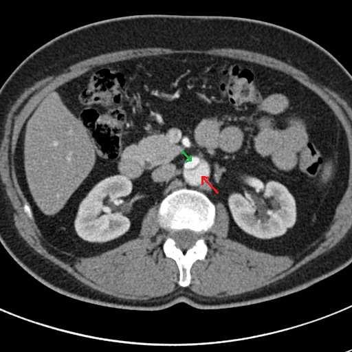 állumen. [10] 6. ábra: Aorta dissectio kialakulásának sémás rajza 7. ábra: Axiális CT felvétel, piros nyíl jelöli az állument, a zöld nyíl mutatja a valódi lument.