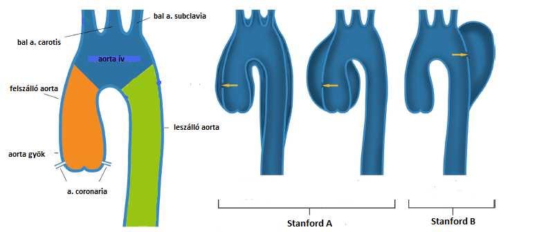 A modern felosztás (kórházunkban ezt alkalmazzák) a Stanford/Daily, A és B típusról beszél aszerint, hogy típusosan a billentyűsík felett vagy a bal a. subclavia alatt történik a berepedés. [10] 8.