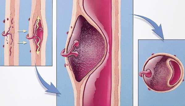 A aorta dissectio kimutatására az MDCT-A kiváló módszer. Kontrasztanyag adás után a curved MPR-képeken jól elkülöníthető az intima flap, a beszakadás kezdete és vége.
