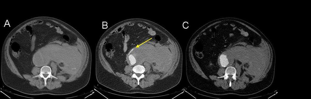 14. ábra: Aorta aneurysma sémás rajza A mellkasi aorta ruptura leggyakoribb oka az aorta aneurysmája, dissectioja, decelerációs traumája, exulcerált plaque-ja és intramuralis haematoma.