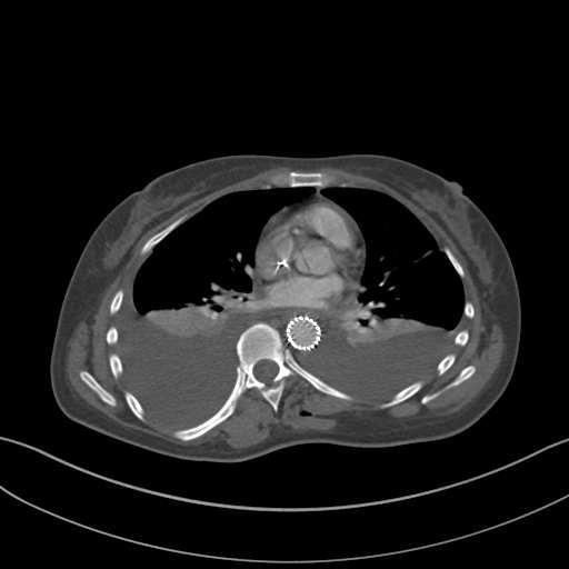 18. ábra: axiális CT felvétel, melyen EVAR technikával kezelt aorta szakasz látható 3.