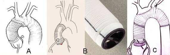 Aorta dissectio esetén a műtéti kezelés célja, hogy az érintett aorta szakaszt rekonstruálják.