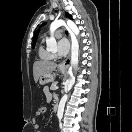 subclavia eredésétől az aorta bifurcatioig terjedő dissectio látható.