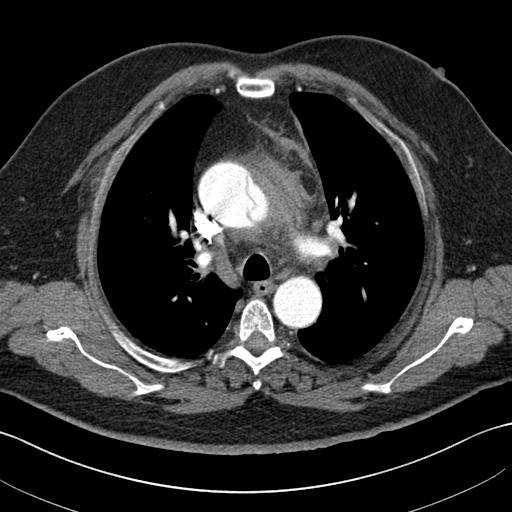 2 cm. Az állumenben az aorta descendensben a rekesz magasságáig thrombus látható, mely félhold alakú.