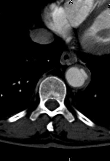 73 éves nőbeteg, hirtelen mellkas fájdalma alakult ki, bal alsó végtagja is elzsibbadt. Aorta dissectio gyanú miatt kezelő orvosa CTA vizsgálatot kért.