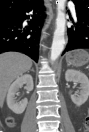 carotis communis kezdeti szakaszán, a. subclavia kezdetén is megfigyelhető. Az aorta descendens mellkasi szakasza 33x36mm átmérőjű, rekesz magasságában tortuózus lefutás észlelhető.