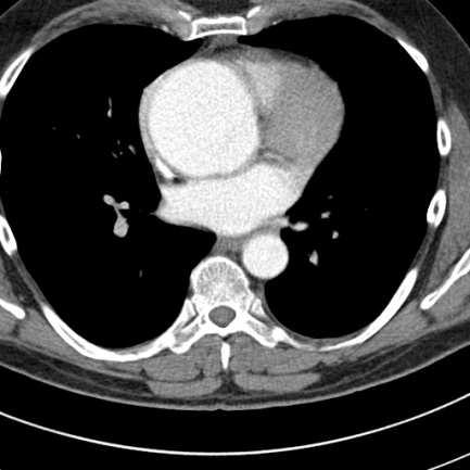 6. eset 42 éves férfi beteg. A bulbus aortae jelentősen tágult, legnagyobb átmérője 75mm, az arcus és a descendens aorta normál tágasságú.