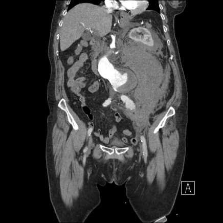 Nyílt műtéti kezeléssel a bal retroperitoneumba tört megrepedt aneurysmát resecalták, aorto-aorticus interpositumot ültettek be. A hasi aortán a renalisok eredésétől kb.