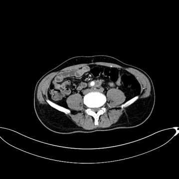 9. eset A betegnek 2012 nyarán aorta aneurysma miatt endograft lett beültetve.