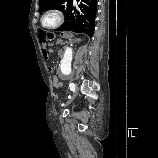 12cm hosszúságú aorta aneurysma látható, mely az oszlásra nem terjed, legnagyobb