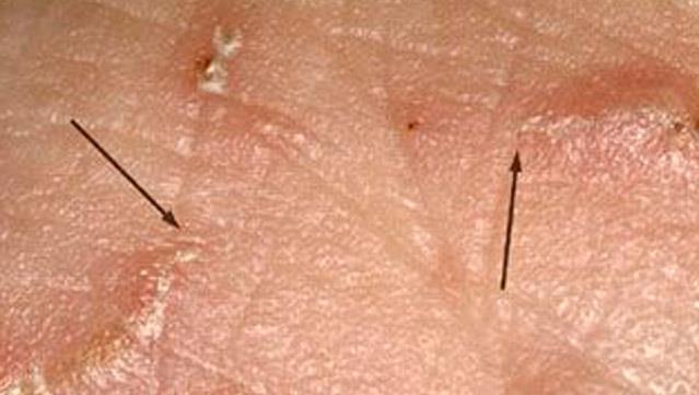 scabicidum FoNo, Infectoscab (permethrin 5% emulziója) Pediculosis (tetvesség)