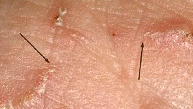 scabicidum FoNo, Infectoscab (permethrin 5% emulziója) Pediculosis (tetvesség)