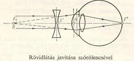 A szem szférikus törőerő eltéréseinek teljes korrekciója a) Ha túl