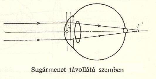A távollátó szem A távollátó szem törőereje nem elég nagy ahoz, hogy a síkhullám frontokat a retinán