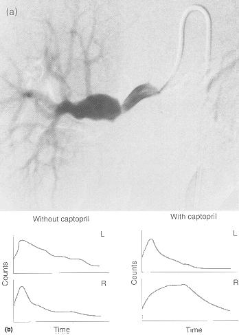 Arteria renalis stenosis Digitalis substractios angiografia a: captopril előtt b: 1