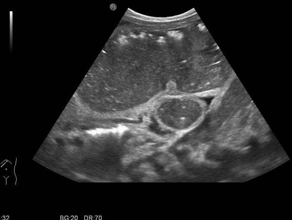 2. ábra. Hasi ultrahangvizsgálat. Az első beteg a születése napján.