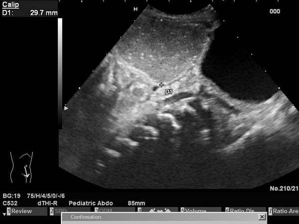 Hasi ultrahangvizsgálaton a hólyag mögött és fölött 30-35 mm átmérőjű, tömlőszerű, valószínűleg béltartalommal telt vastagbélnek megfelelő képlet látszott. A kép distalis colonatresiának megfelelt (4.