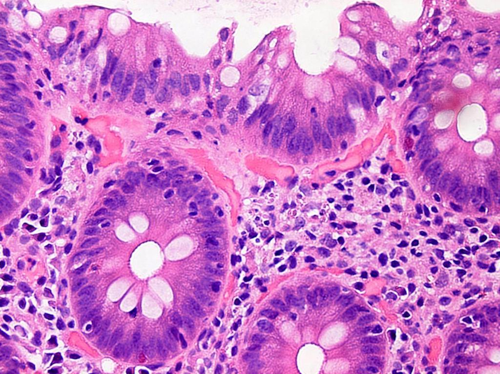 Lymphocytás colitis: