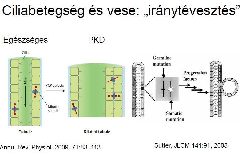 ADPKD -