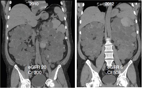 Az ADPKD CT