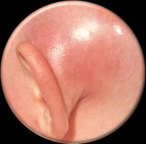 Mastoiditis Subperiostealis tályog