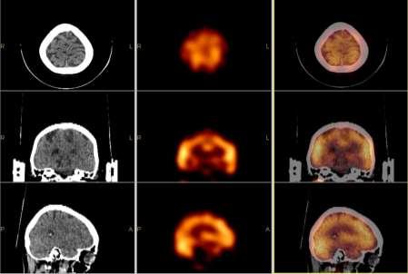 SPECT/CT