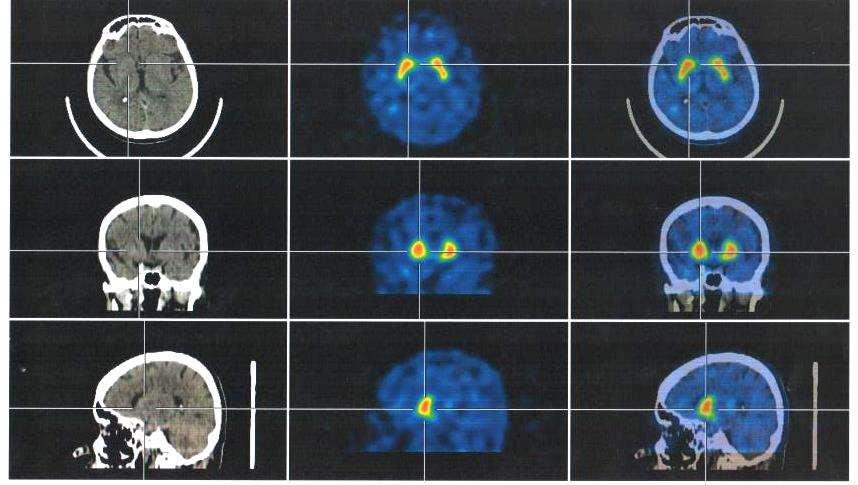 DaTScan SPECT/CT