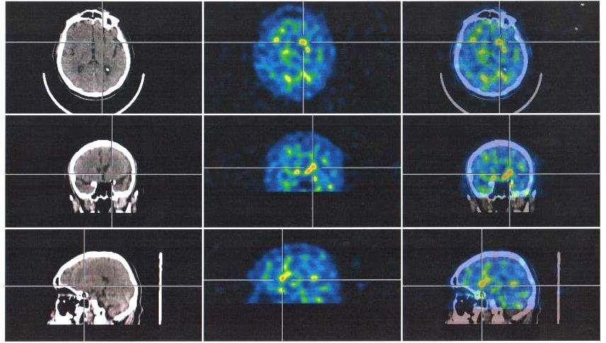 DaTScan SPECT/CT