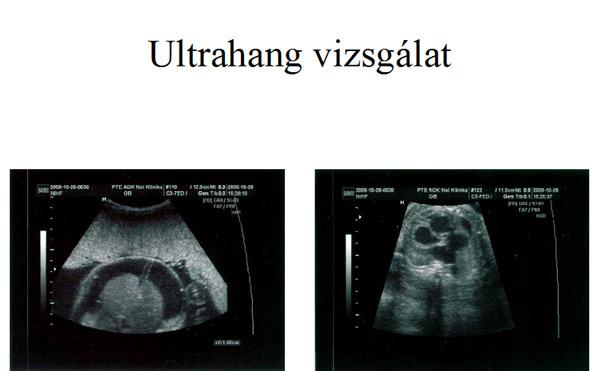 Foetopatológiai vizsgálatok 172 abortum vizsgálata történt 121 terápiás abortusz után: KIR rendellenesség 45 (37%) Húgy-ivarszervi rendellenesség: 12 (10%) Gastrointestinalis rendellenesség: 25 (21%)