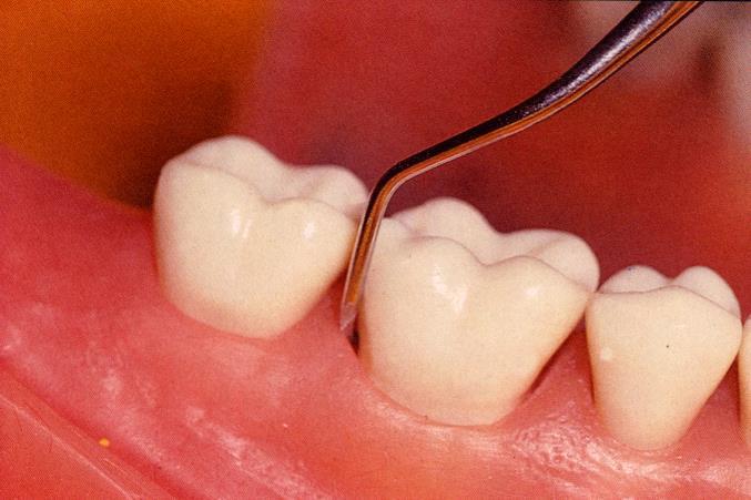 A vágóél különböző angulációinak hatása a fogfelszínre Megfelelő anguláció