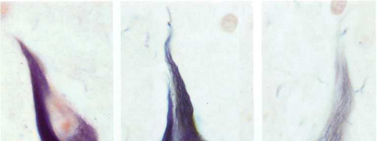 ß-amyloid (1984): amyloidprecursor