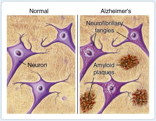 Alzheimer kór v Primer neurodegeneratív betegség v Legfőbb kockázati tényezője az életkor v Etiopatogenezise ismeretlen hipotézisek: 3-as típusú diabetes (lokális agyi inzulinrezisztencia)