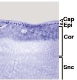 Alzheimer kór szemet érintő komplikációk Amiloid plakkok lerakódása a szemben Retina