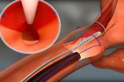 Safestich Safestich gastroplastica transoralis
